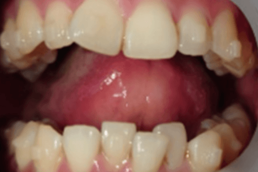 6 Month Aligner Treatment - Before