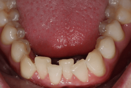 Aligners - Bottom Teeth - Before