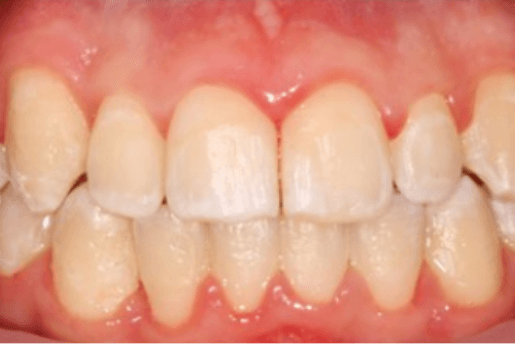Braces - After