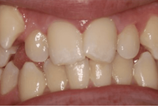 Braces - Before